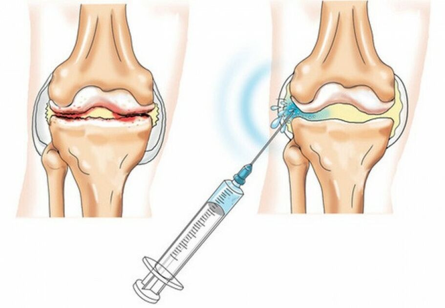 injection dans l'articulation du genou souffrant d'arthrose