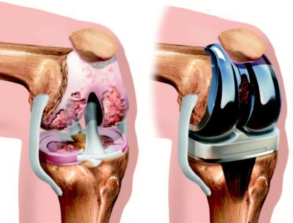 En cas de lésion complète de l'articulation du genou due à l'arthrose, celle-ci peut être restaurée à l'aide d'endoprothèses.